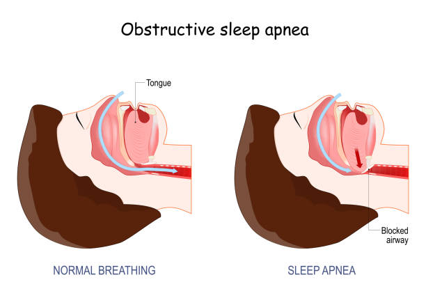 obstructive sleep amnea